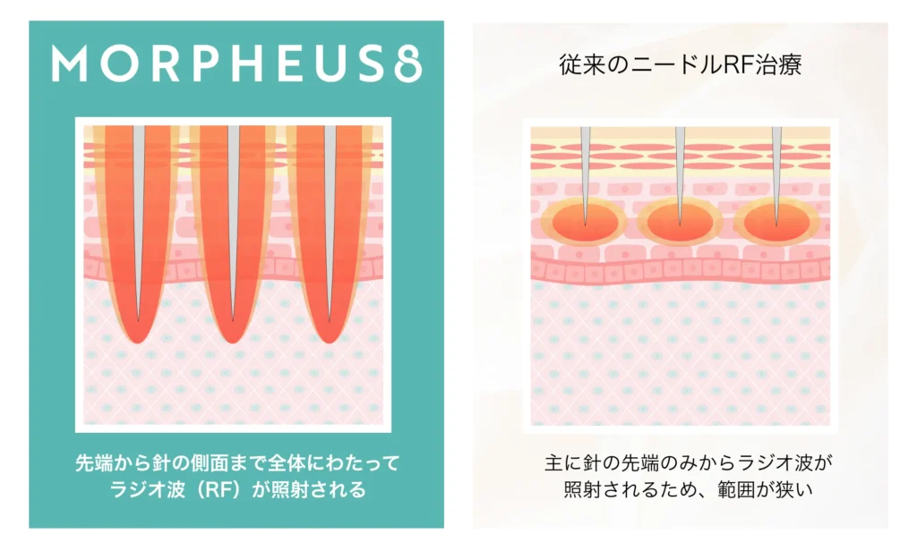 ニードルRF比較